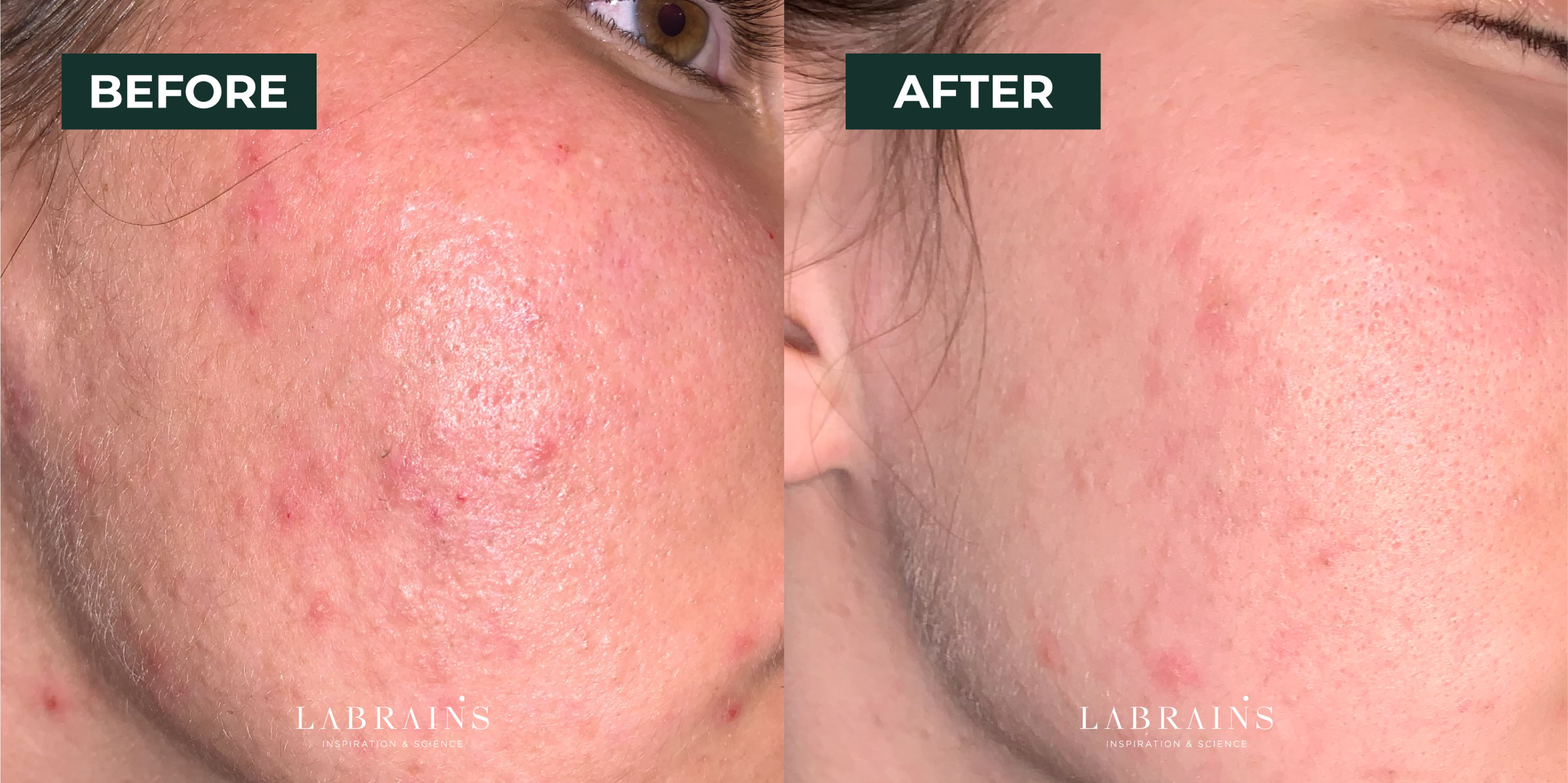 sensitive skin gentle facial treatment Dubai, Abu Dhabi before and after